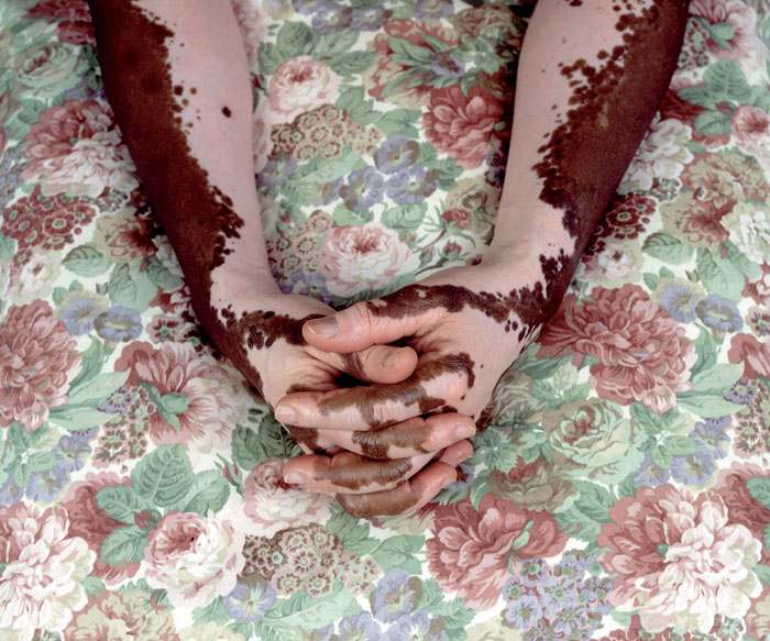 Eczema: Why the Same Diagnosis Needs Different Remedies