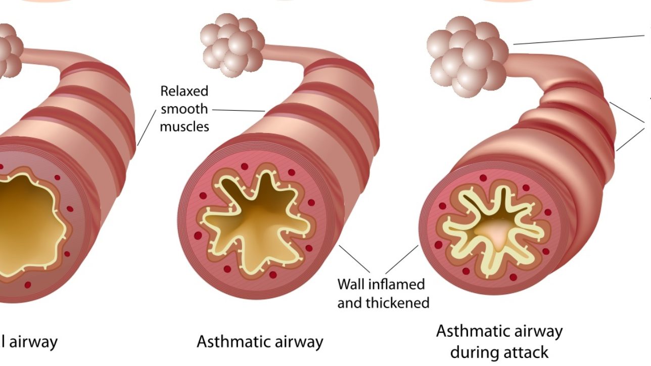 Breathe Easy: A Homeopathic Practitioner’s Complete Guide to Healing Asthma Naturally