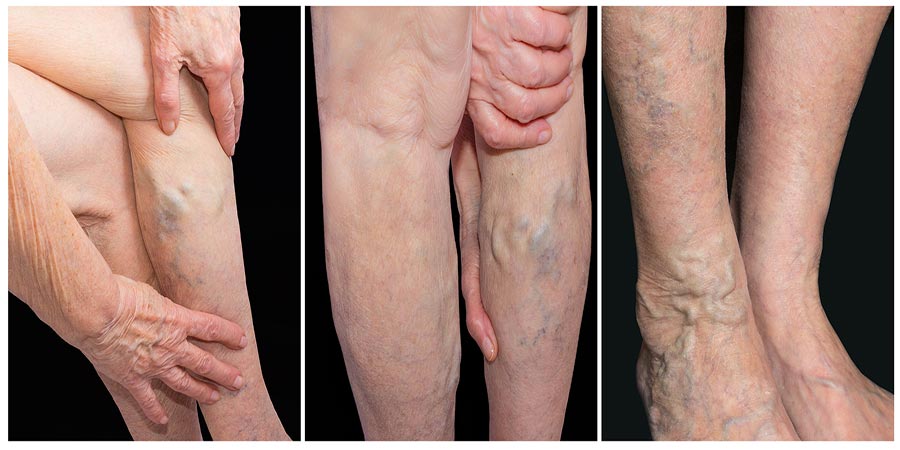 Say Goodbye to Spider Veins: A Complete Homeopathic Guide to Varicose Veins