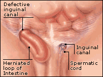 hernia