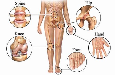 Fight Out Arthritis: Your Ultimate Guide to Symptoms & Homeopathic Relief