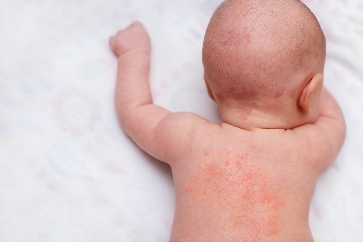 Soothing Your Baby's Skin Rashes: A Gentle Homeopathic Approach