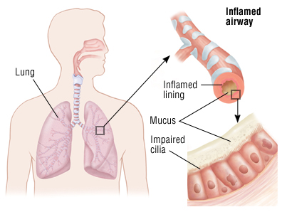 Break the Cycle: A Homeopathic Guide to Conquering Frequent Colds