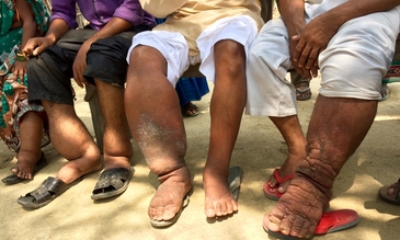 Understanding Filariasis (Elephantiasis): Causes, Detection, and Holistic Management