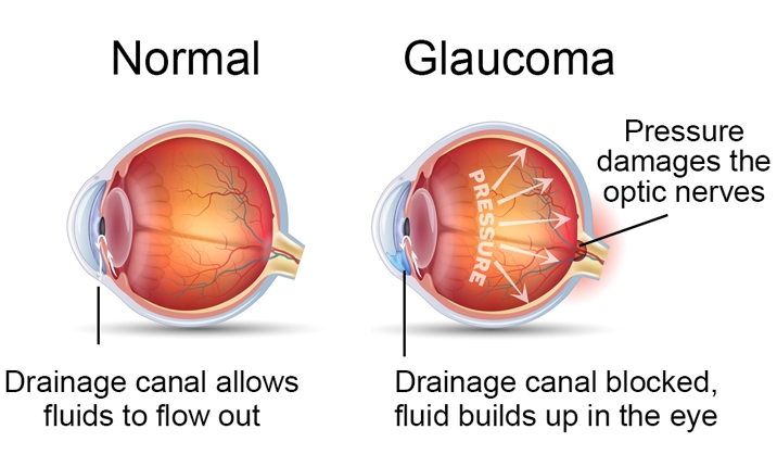 glaucoma-cause