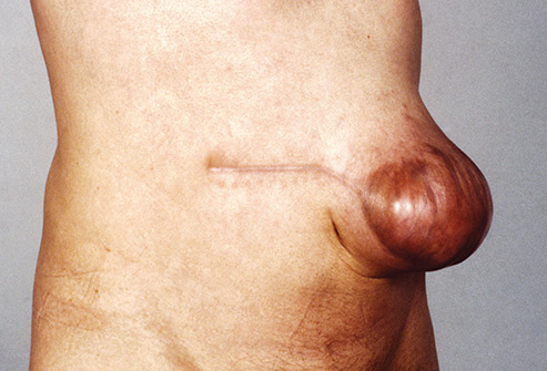 Hernia: Homeopathic Remedy Indications & Materia Medica
