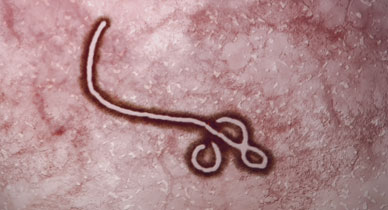 Hydrophobinum (Lyssinum) होम्योपैथिक दवा: लक्षण, फायदे और उपयोग (Materia Medica)