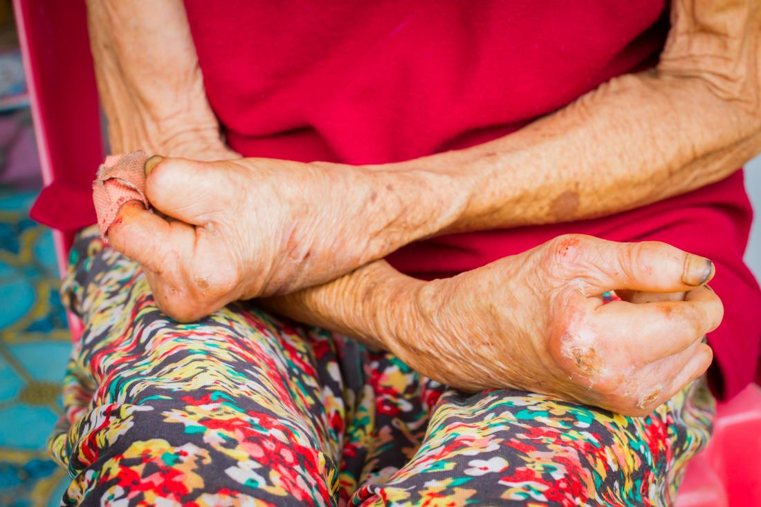 Leprosy (Hansen's Disease): Overview, Pathology, and Homeopathic Therapeutics