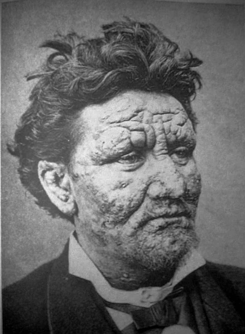 leprosy