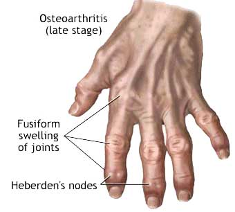 osteoarthritis-late