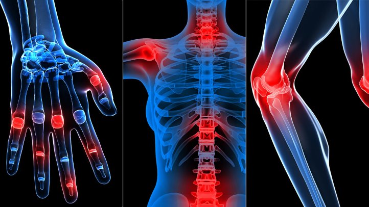 Say Goodbye to Joint Pain: The Ultimate Diet & Lifestyle Guide for Rheumatic Diseases