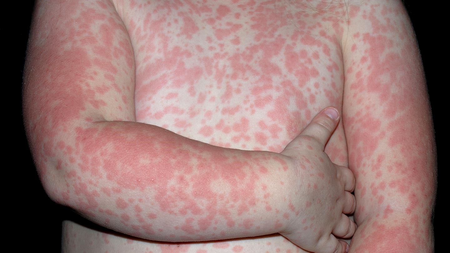 Understanding Eczema: A Simple Guide to Symptoms, Triggers, and Relief
