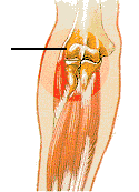 tennis-elbow-relief