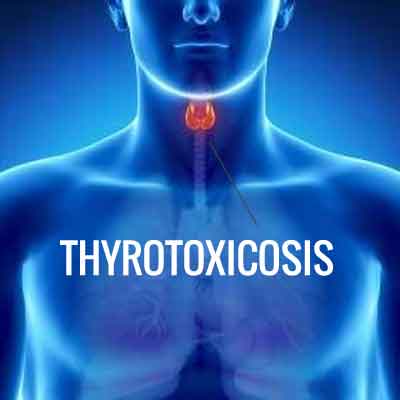 A Clinical Guide to Thyroid Dysfunction: Thyrotoxicosis, Hyperthyroidism, and Homeopathic Therapeutics