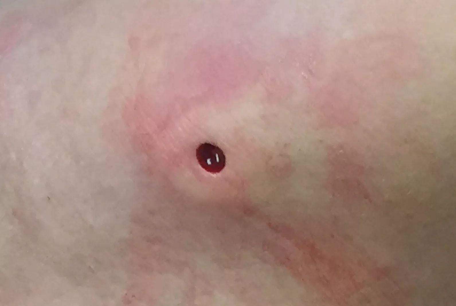 How to Treat an Abscess with Homeopathy: A Complete Guide
