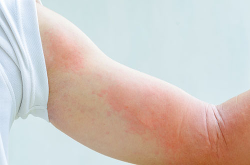 Itchy, Red, and Swollen? The Ultimate Homeopathic Guide to Healing Rashes & Hives